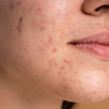 hormonal acne, fungal acne, bacterial acne