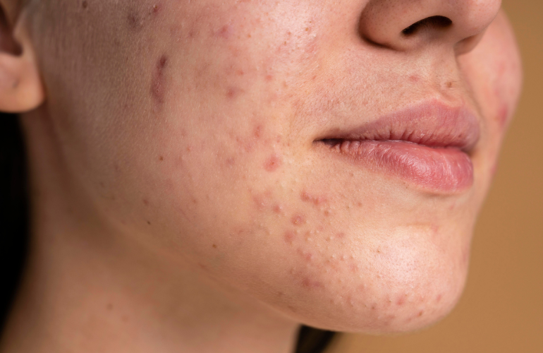 hormonal acne, fungal acne, bacterial acne